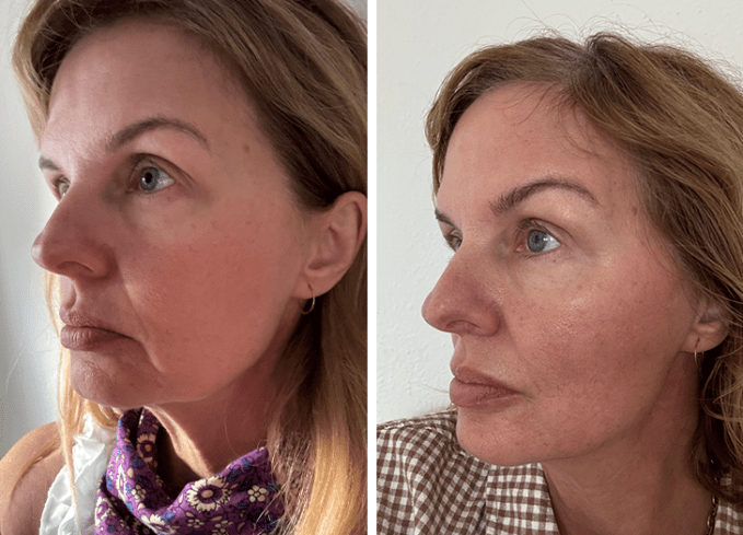 nira laser review: dana before and after